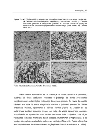 Introdução | 32
Figura 7 - (A) Células poliédricas grandes, tipo celular mais comum nos nevos de coroide.
(B) Células fusiformes delgadas, segundo tipo celular mais comum. (C) Células
fusiformes grandes e dendríticas grandes. É possível visualizar projeções
dendríticas de citoplasma pigmentado e núcleo largo (seta preta). (D) Células
balão (BC)
Fonte: Adaptada de Naumann; Yanoff e Zimmerman (1966).
Além dessas características, a presença de vasos estreitos e paralelos,
ausência de alças vasculares fechadas e presença de zonas avasculares
corroboram com o diagnóstico histológico de nevo de coroide. Os nevos de coroide
crescem em volta de vasos sanguíneos normais e possuem junções de células
endoteliais intactas, igualmente à coroide normal (Figura 8). Apesar de os
melanomas também poderem crescer em volta de vasos sanguíneos normais,
normalmente se apresentam com tramas vasculares mais complexas, com alças
vasculares fechadas, membrana basal espessa, multilaminar e fragmentada, e as
junções das células endoteliais podem ser perdidas (Figura 8). Essas alterações
estruturais também estão associadas à angiogênese tumoral (Rummelt et al., 1994).
A B
C D
 