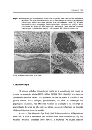 Introdução | 33
Figura 8 - Histopatologia da arquitetura da microcirculação no nevo de coroide e melanoma.
(A) Nevo com suas células em torno de um vaso sanguíneo normal (N). (B) Nevo
melanocítico. Membrana basal vascular fina e homogênea (seta). (C) Achados
histopatológicos da arquitetura da microcirculação no melanoma maligno. Alças
vasculares fechadas (L). (D) Melanoma. Membrana basal vascular espessa,
fragmentada e multilaminar (setas). L= lipofucsina; M= célula do melanoma
Fonte: Adaptada de Rummelt et al. (1994).
1.5 Epidemiologia
Há poucos estudos populacionais relatando a prevalência dos nevos de
coroide na população adulta (BMES, MESA, CIEMS, BES, NHANES) e as taxas de
prevalência descritas variam, principalmente, no que se refere à prevalência nos
grupos étnicos. Essa variação, provavelmente, se deve às diferenças nas
populações estudadas, nos diferentes métodos de avaliação e na diferença de
pigmentação do fundo de olho entre as etnias, que pode influenciar na detecção
oftalmoscópica dos nevos de coroide.
No estudo Blue Mountains Eye Study (BMES) foram avaliados 3654 pacientes
entre 1992 e 1994 e detectados 232 pacientes com nevo de coroide (6,5%), não
havendo diferença estatística entre homens e mulheres. As drusas estavam
A B
C D
 