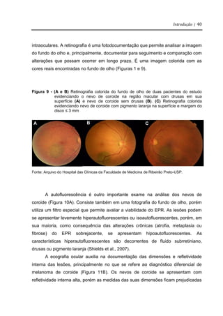 Introdução | 40
intraoculares. A retinografia é uma fotodocumentação que permite analisar a imagem
do fundo do olho e, principalmente, documentar para seguimento e comparação com
alterações que possam ocorrer em longo prazo. É uma imagem colorida com as
cores reais encontradas no fundo de olho (Figuras 1 e 9).
Figura 9 - (A e B) Retinografia colorida do fundo de olho de duas pacientes do estudo
evidenciando o nevo de coroide na região macular com drusas em sua
superfície (A) e nevo de coroide sem drusas (B). (C) Retinografia colorida
evidenciando nevo de coroide com pigmento laranja na superfície e margem do
disco ≤ 3 mm
Fonte: Arquivo do Hospital das Clínicas da Faculdade de Medicina de Ribeirão Preto-USP.
A autofluorescência é outro importante exame na análise dos nevos de
coroide (Figura 10A). Consiste também em uma fotografia do fundo de olho, porém
utiliza um filtro especial que permite avaliar a viabilidade do EPR. As lesões podem
se apresentar levemente hiperautofluorescentes ou isoautofluorescentes, porém, em
sua maioria, como consequência das alterações crônicas (atrofia, metaplasia ou
fibrose) do EPR sobrejacente, se apresentam hipoautofluorescentes. As
características hiperautofluorescentes são decorrentes de fluido subrretiniano,
drusas ou pigmento laranja (Shields et al., 2007).
A ecografia ocular auxilia na documentação das dimensões e refletividade
interna das lesões, principalmente no que se refere ao diagnóstico diferencial de
melanoma de coroide (Figura 11B). Os nevos de coroide se apresentam com
refletividade interna alta, porém as medidas das suas dimensões ficam prejudicadas
C
A B
 