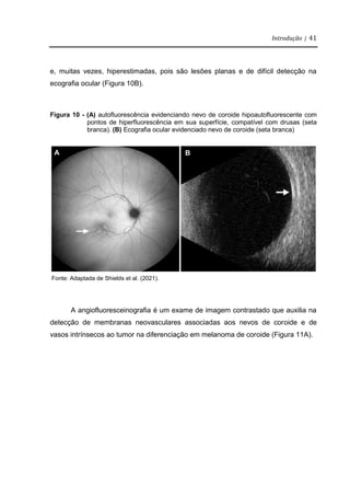 Introdução | 41
e, muitas vezes, hiperestimadas, pois são lesões planas e de difícil detecção na
ecografia ocular (Figura 10B).
Figura 10 - (A) autofluorescência evidenciando nevo de coroide hipoautofluorescente com
pontos de hiperfluorescência em sua superfície, compatível com drusas (seta
branca). (B) Ecografia ocular evidenciado nevo de coroide (seta branca)
Fonte: Adaptada de Shields et al. (2021).
A angiofluoresceinografia é um exame de imagem contrastado que auxilia na
detecção de membranas neovasculares associadas aos nevos de coroide e de
vasos intrínsecos ao tumor na diferenciação em melanoma de coroide (Figura 11A).
A B
 