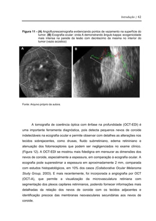 Introdução | 42
Figura 11 - (A) Angiofluoresceinografia evidenciando pontos de vazamento na superfície do
tumor. (B) Ecografia ocular: onda A demonstrando ângulo kappa: ecogenicidade
mais intensa na parede da lesão com decréscimo da mesma no interior do
tumor (vazio acústico)
Fonte: Arquivo próprio da autora.
A tomografia de coerência óptica com ênfase na profundidade (OCT-EDI) é
uma importante ferramenta diagnóstica, pois detecta pequenos nevos de coroide
indetectáveis na ecografia ocular e permite observar com detalhes as alterações nos
tecidos sobrejacentes, como drusas, fluido subrretiniano, edema retininiano e
atenuação dos fotorreceptores que podem ser negligenciados no exame clínico.
(Figura 12). A OCT-EDI se mostrou mais fidedigna em mensurar as dimensões dos
nevos de coroide, especialmente a espessura, em comparação à ecografia ocular. A
ecografia pode superestimar a espessura em aproximadamente 2 mm, comparada
com estudos histopatológicos, em 10% dos casos (Collaborative Ocular Melanoma
Study Group, 2003). E mais recentemente, foi incorporada a angiografia por OCT
(OCT-A), que permite a visualização da microvasculatura retiniana com
segmentação dos plexos capilares retininianos, podendo fornecer informações mais
detalhadas da relação dos nevos de coroide com os tecidos adjacentes e
identificação precoce das membranas neovasculares secundárias aos nevos de
coroide.
A B
 