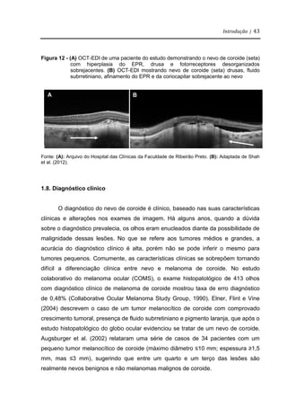 Introdução | 43
Figura 12 - (A) OCT-EDI de uma paciente do estudo demonstrando o nevo de coroide (seta)
com hiperplasia do EPR, drusa e fotorreceptores desorganizados
sobrejacentes. (B) OCT-EDI mostrando nevo de coroide (seta) drusas, fluido
subrretiniano, afinamento do EPR e da coriocapilar sobrejacente ao nevo
Fonte: (A): Arquivo do Hospital das Clínicas da Faculdade de Ribeirão Preto. (B): Adaptada de Shah
et al. (2012).
1.8. Diagnóstico clínico
O diagnóstico do nevo de coroide é clínico, baseado nas suas características
clínicas e alterações nos exames de imagem. Há alguns anos, quando a dúvida
sobre o diagnóstico prevalecia, os olhos eram enucleados diante da possibilidade de
malignidade dessas lesões. No que se refere aos tumores médios e grandes, a
acurácia do diagnóstico clínico é alta, porém não se pode inferir o mesmo para
tumores pequenos. Comumente, as características clínicas se sobrepõem tornando
difícil a diferenciação clínica entre nevo e melanoma de coroide. No estudo
colaborativo do melanoma ocular (COMS), o exame histopatológico de 413 olhos
com diagnóstico clínico de melanoma de coroide mostrou taxa de erro diagnóstico
de 0,48% (Collaborative Ocular Melanoma Study Group, 1990). Elner, Flint e Vine
(2004) descrevem o caso de um tumor melanocítico de coroide com comprovado
crescimento tumoral, presença de fluido subrretiniano e pigmento laranja, que após o
estudo histopatológico do globo ocular evidenciou se tratar de um nevo de coroide.
Augsburger et al. (2002) relataram uma série de casos de 34 pacientes com um
pequeno tumor melanocítico de coroide (máximo diâmetro ≤10 mm; espessura ≥1,5
mm, mas ≤3 mm), sugerindo que entre um quarto e um terço das lesões são
realmente nevos benignos e não melanomas malignos de coroide.
B
A
 