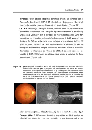 Casuística e Métodos | 59
Infra-red: Foram obtidas fotografias com filtro próximo ao infra-red com o
Tomógrafo Spectralis® HRA+OCT (Heidelberg Engineering, Germany),
visando documentar os nevos de coroide no fundo de olho. (Figura 18B)
OCT-EDI: A avaliação da região macular, onde os nevos de coroide estavam
localizados, foi realizada pelo Tomógrafo Spectralis® HRA+OCT (Heidelberg
Engineering, Germany) com o protocolo de rastreamento padrão 20º x 15º,
consistindo em 19 seções horizontais (cada uma a partir de 25 quadros) com
distância de 240 μm entre cada scan, cobrindo o quadrilátero de 20 x 15
graus na retina, centrado na fóvea. Foram realizados os scans na área do
nevo para documentar a imagem próximo ao infra-red e avaliar a espessura
das lesões e a integridade da retina e do EPR sobrejacente aos nevos de
coroide. A OCT-EDI também foi utilizada para avaliar a presença de fluido
subrretiniano (Figura 18C).
Figura 18 - (A) Fotografia colorida de fundo de olho mostrando nevo coroidal localizado
inferonasal à fóvea. (B) A imagem em infravermelho do nevo de coroide
mostrando sua superfície hiperrefletiva. (C) A tomografia de coerência óptica
de domínio espectral com imagem de profundidade aprimorada exibe
hiporrefletividade sutil das camadas elipsoide, fotorreceptores e camadas do
EPR; e hiperrefletividade do tumor melanocítico com sombra posterior
projetando-se na coroide (pontas de seta)
Microperimetria (MAIA - Macular Integrity Assessment; CenterVue SpA,
Padova, Itália). O MAIA é um dispositivo que utiliza um SLO próximo ao
infra-red, em conjunto com um rastreador ocular (eye-tracker) e um
 
