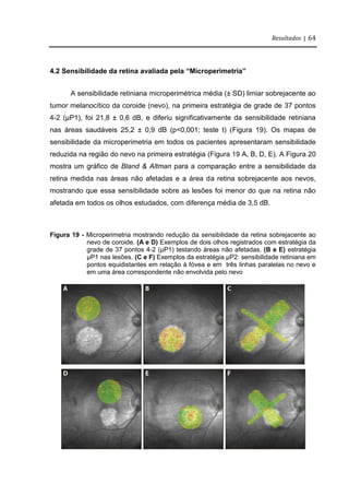 Resultados | 64
4.2 Sensibilidade da retina avaliada pela “Microperimetria”
A sensibilidade retiniana microperimétrica média (± SD) limiar sobrejacente ao
tumor melanocítico da coroide (nevo), na primeira estratégia de grade de 37 pontos
4-2 (μP1), foi 21,8 ± 0,6 dB, e diferiu significativamente da sensibilidade retiniana
nas áreas saudáveis 25,2 ± 0,9 dB (p<0,001; teste t) (Figura 19). Os mapas de
sensibilidade da microperimetria em todos os pacientes apresentaram sensibilidade
reduzida na região do nevo na primeira estratégia (Figura 19 A, B, D, E). A Figura 20
mostra um gráfico de Bland & Altman para a comparação entre a sensibilidade da
retina medida nas áreas não afetadas e a área da retina sobrejacente aos nevos,
mostrando que essa sensibilidade sobre as lesões foi menor do que na retina não
afetada em todos os olhos estudados, com diferença média de 3,5 dB.
Figura 19 - Microperimetria mostrando redução da sensibilidade da retina sobrejacente ao
nevo de coroide. (A e D) Exemplos de dois olhos registrados com estratégia da
grade de 37 pontos 4-2 (μP1) testando áreas não afetadas. (B e E) estratégia
μP1 nas lesões. (C e F) Exemplos da estratégia μP2: sensibilidade retiniana em
pontos equidistantes em relação à fóvea e em três linhas paralelas no nevo e
em uma área correspondente não envolvida pelo nevo
 