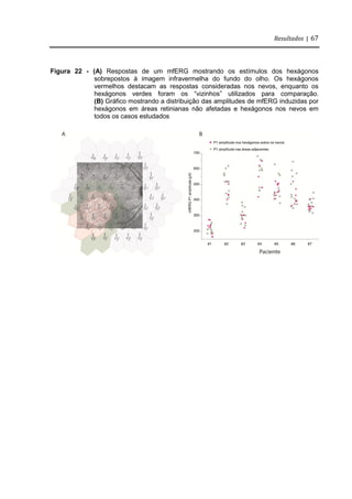 Resultados | 67
Figura 22 - (A) Respostas de um mfERG mostrando os estímulos dos hexágonos
sobrepostos à imagem infravermelha do fundo do olho. Os hexágonos
vermelhos destacam as respostas consideradas nos nevos, enquanto os
hexágonos verdes foram os “vizinhos” utilizados para comparação.
(B) Gráfico mostrando a distribuição das amplitudes de mfERG induzidas por
hexágonos em áreas retinianas não afetadas e hexágonos nos nevos em
todos os casos estudados
 