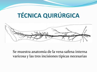 TÉCNICA QUIRÚRGICA
Se muestra anatomía de la vena safena interna
varicosa y las tres incisiones típicas necesarias
 