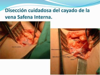 Disección cuidadosa del cayado de la
vena Safena Interna.
 