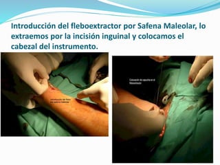 Introducción del fleboextractor por Safena Maleolar, lo
extraemos por la incisión inguinal y colocamos el
cabezal del instrumento.
 