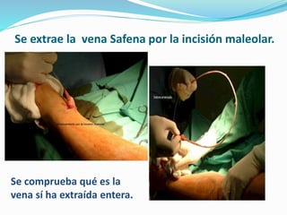 Se extrae la vena Safena por la incisión maleolar.
Se comprueba qué es la
vena sí ha extraída entera.
 