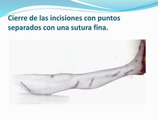 Cierre de las incisiones con puntos
separados con una sutura fina.
 