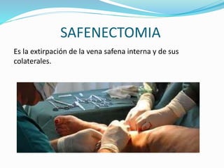 SAFENECTOMIA
Es la extirpación de la vena safena interna y de sus
colaterales.
 