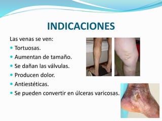 INDICACIONES
Las venas se ven:
 Tortuosas.
 Aumentan de tamaño.
 Se dañan las válvulas.
 Producen dolor.
 Antiestéticas.
 Se pueden convertir en úlceras varicosas.
 
