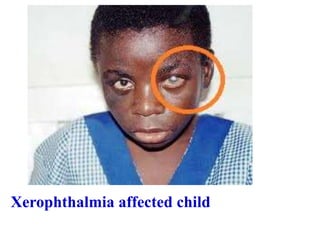 Xerophthalmia affected child
 