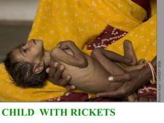 CHILD WITH RICKETS
 