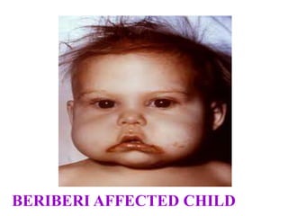 BERIBERI AFFECTED CHILD
 