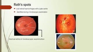 Markers of Infective Endooocarditis.pptx