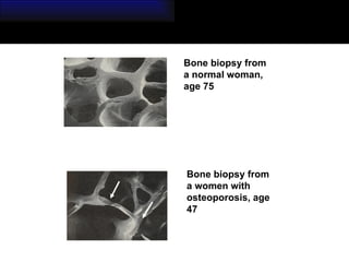 Bone biopsy from a normal woman, age 75 Bone biopsy from a women with osteoporosis, age 47 