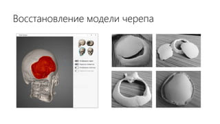 Восстановление модели черепа
 