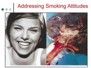 Addressing Smoking Attitudes
 