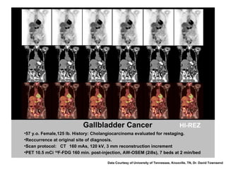 Gallbladder Cancer ,[object Object],[object Object],[object Object],[object Object],Data Courtesy of University of Tennessee, Knoxville, TN, Dr. David Townsend  HI-REZ 