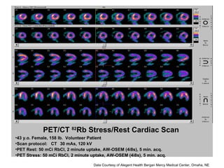 PET/CT  82 Rb Stress/Rest Cardiac Scan ,[object Object],[object Object],[object Object],[object Object],Data Courtesy of Alegent Health Bergan Mercy Medical Center, Omaha, NE 