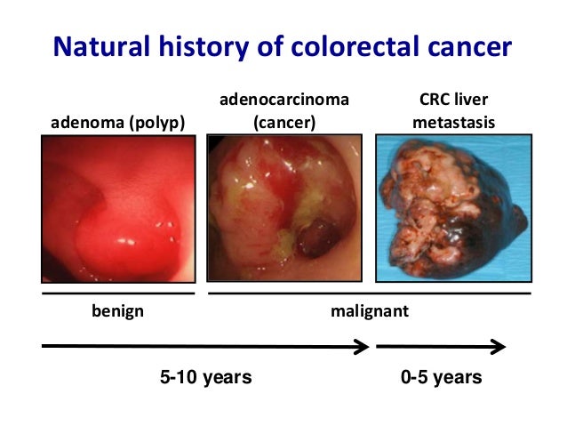 Colon Cancer Natural History Colon Cancer Natural History