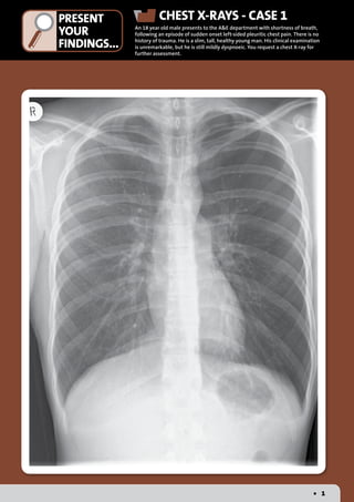 PRESENT
YOUR
FINDINGS...
	 	 •	 1
	 CHEST X-RAYS - CASE 1
An 18 year old male presents to the A&E department with shortness of breath,
following an episode of sudden onset left-sided pleuritic chest pain. There is no
history of trauma. He is a slim, tall, healthy young man. His clinical examination
is unremarkable, but he is still mildly dyspnoeic. You request a chest X-ray for
further assessment.
 
