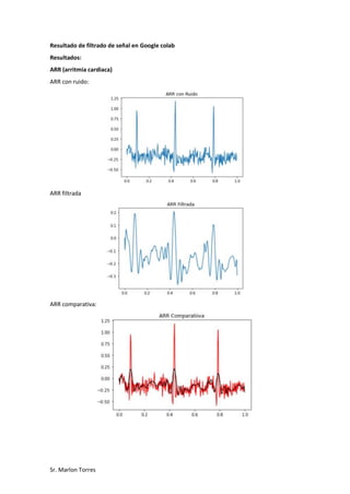Sr. Marlon Torres
Resultado de filtrado de señal en Google colab
Resultados:
ARR (arritmia cardiaca)
ARR con ruido:
ARR filtrada
ARR comparativa:
 