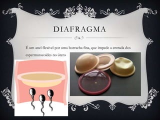 DIAFRAGMA
É um anel flexível por uma borracha fina, que impede a entrada dos
espermatozoides no útero
 