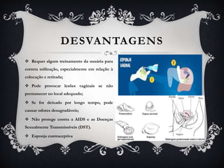 DESVANTAGENS
 Requer algum treinamento da usuária para
correta utilização, especialmente em relação à
colocação e retirada;
 Pode provocar lesões vaginais se não
permanecer no local adequado;
 Se for deixado por longo tempo, pode
causar odores desagradáveis;
 Não protege contra a AIDS e as Doenças
Sexualmente Transmissíveis (DST).
 Esponja contraceptiva
 
