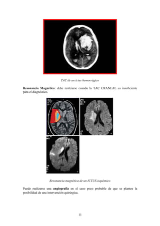 TAC de un ictus hemorrágico

Resonancia Magnética: debe realizarse cuando la TAC CRANEAL es insuficiente
para el diagnóstico.




                  Resonancia magnética de un ICTUS isquémico

Puede realizarse una angiografía en el caso poco probable de que se plantee la
posibilidad de una intervención quirúrgica.




                                     11
 