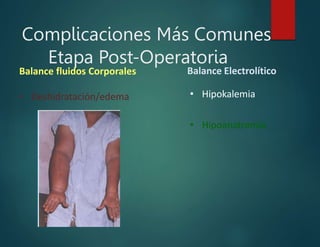 Complicaciones Más Comunes
Etapa Post-Operatoria
• Deshidratación/edema
Balance fluidos Corporales Balance Electrolítico
• Hipokalemia
• Hipoanatremia
 