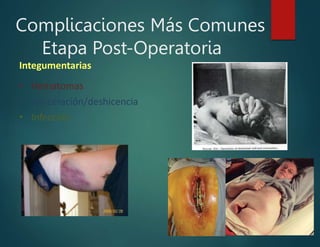 Complicaciones Más Comunes
Etapa Post-Operatoria
Integumentarias
• Hematomas
• Evisceración/deshicencia
• Infección
 