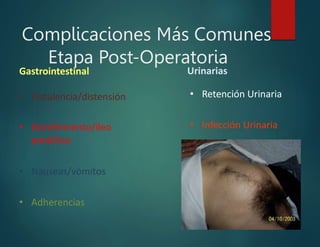 Complicaciones Más Comunes
Etapa Post-Operatoria
• Flatulencia/distensión
• Estreñimiento/íleo
paralítico
• Nauseas/vómitos
• Adherencias
Gastrointestinal Urinarias
• Retención Urinaria
• Infección Urinaria
 