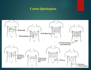 Cortes Quirúrgicos
 