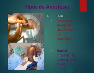 Tipos de Anestesia
 I. Local
• Perdida de
sensación
sin pérdida
de
conciencia
• Topical,
Intraespinal,
o inyección a
tejido
 