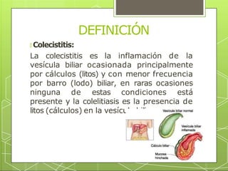 DEFINICIÓN
🞇 Colecistitis:
La colecistitis es la inflamación de la
vesícula biliar ocasionada principalmente
por cálculos (litos) y con menor frecuencia
por barro (lodo) biliar, en raras ocasiones
ninguna de estas condiciones está
presente y la colelitiasis es la presencia de
litos (cálculos) en la vesícula biliar.
 