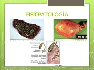 FISIOPATOLOGÍA
 