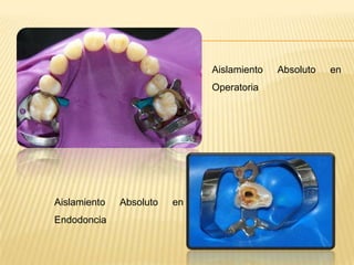 Aislamiento Absoluto en
Operatoria
Aislamiento Absoluto en
Endodoncia
 