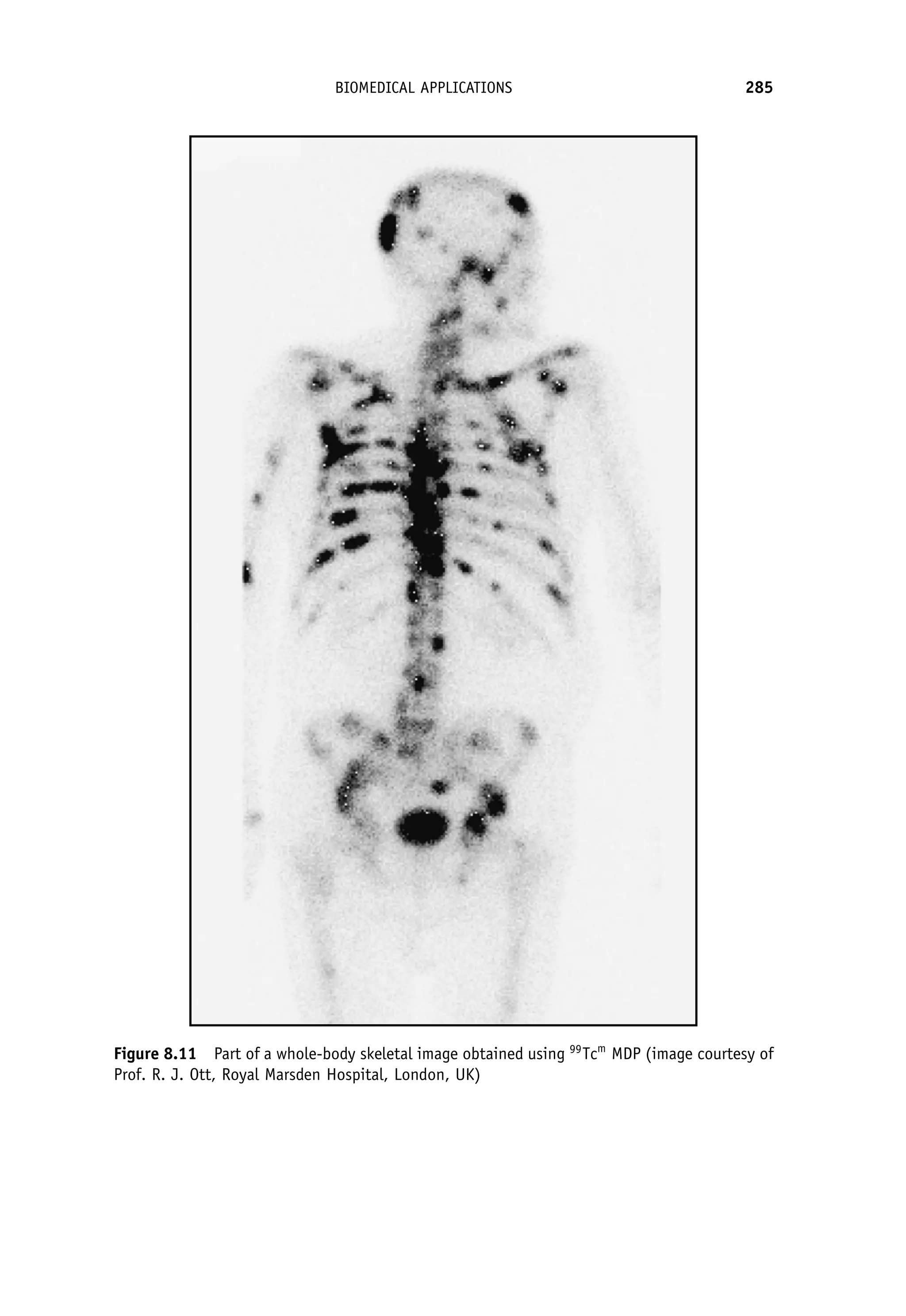 Figure 8.11 Part of a whole-body skeletal image obtained using 99
Tcm
MDP (image courtesy of
Prof. R. J. Ott, Royal Marsden Hospital, London, UK)
BIOMEDICAL APPLICATIONS 285
 
