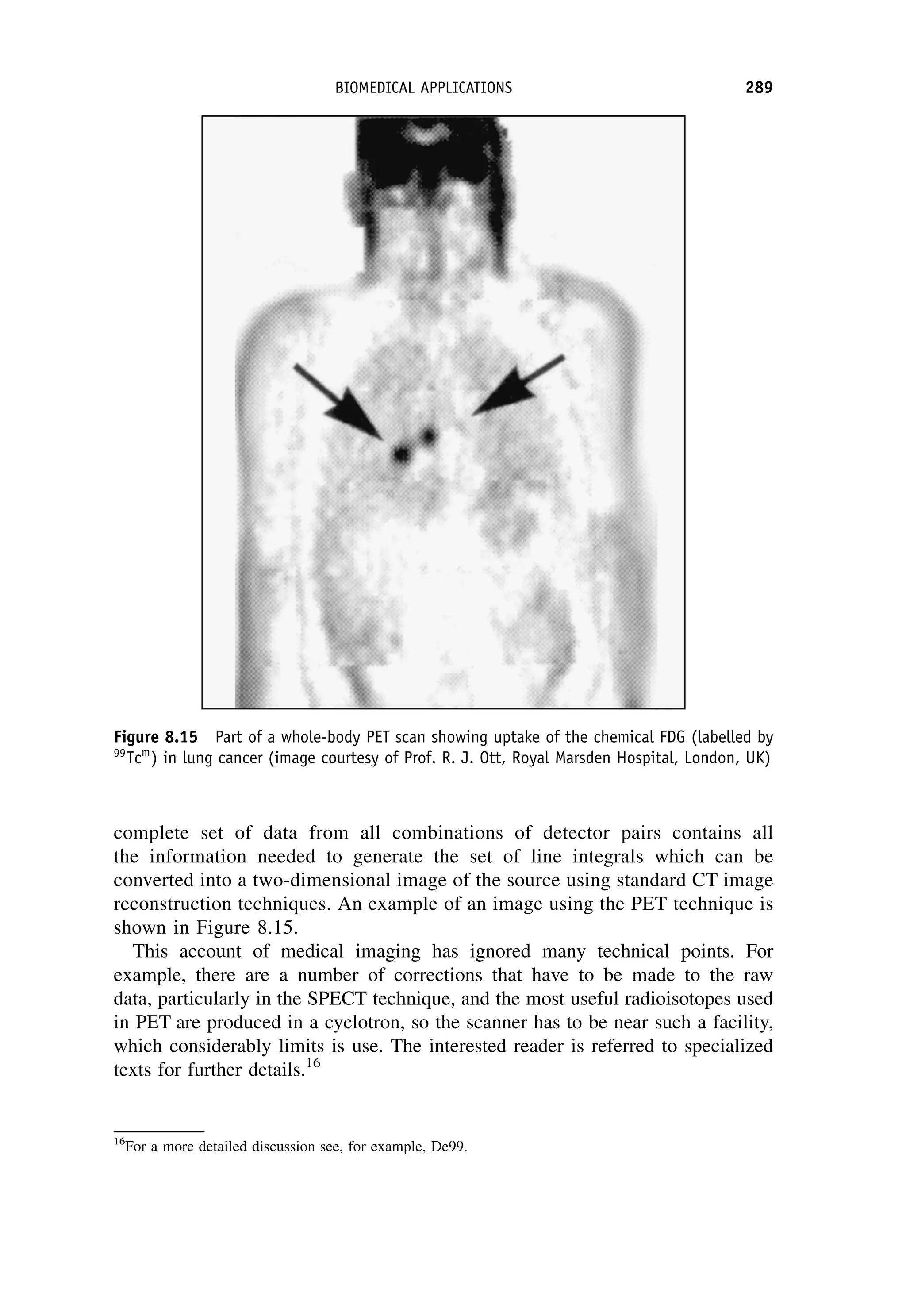 complete set of data from all combinations of detector pairs contains all
the information needed to generate the set of line integrals which can be
converted into a two-dimensional image of the source using standard CT image
reconstruction techniques. An example of an image using the PET technique is
shown in Figure 8.15.
This account of medical imaging has ignored many technical points. For
example, there are a number of corrections that have to be made to the raw
data, particularly in the SPECT technique, and the most useful radioisotopes used
in PET are produced in a cyclotron, so the scanner has to be near such a facility,
which considerably limits is use. The interested reader is referred to specialized
texts for further details.16
Figure 8.15 Part of a whole-body PET scan showing uptake of the chemical FDG (labelled by
99
Tcm
) in lung cancer (image courtesy of Prof. R. J. Ott, Royal Marsden Hospital, London, UK)
16
For a more detailed discussion see, for example, De99.
BIOMEDICAL APPLICATIONS 289
 