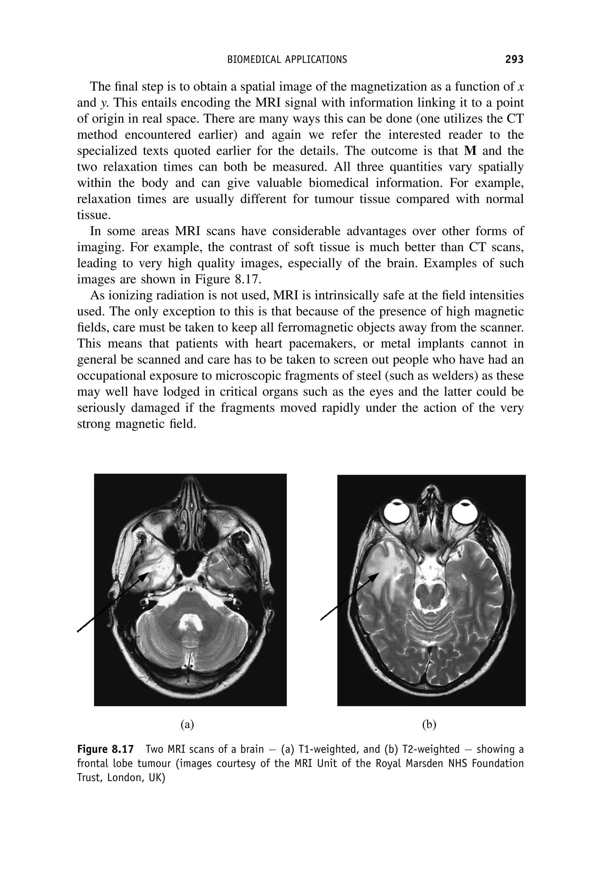 The final step is to obtain a spatial image of the magnetization as a function of x
and y. This entails encoding the MRI signal with information linking it to a point
of origin in real space. There are many ways this can be done (one utilizes the CT
method encountered earlier) and again we refer the interested reader to the
specialized texts quoted earlier for the details. The outcome is that M and the
two relaxation times can both be measured. All three quantities vary spatially
within the body and can give valuable biomedical information. For example,
relaxation times are usually different for tumour tissue compared with normal
tissue.
In some areas MRI scans have considerable advantages over other forms of
imaging. For example, the contrast of soft tissue is much better than CT scans,
leading to very high quality images, especially of the brain. Examples of such
images are shown in Figure 8.17.
As ionizing radiation is not used, MRI is intrinsically safe at the field intensities
used. The only exception to this is that because of the presence of high magnetic
fields, care must be taken to keep all ferromagnetic objects away from the scanner.
This means that patients with heart pacemakers, or metal implants cannot in
general be scanned and care has to be taken to screen out people who have had an
occupational exposure to microscopic fragments of steel (such as welders) as these
may well have lodged in critical organs such as the eyes and the latter could be
seriously damaged if the fragments moved rapidly under the action of the very
strong magnetic field.
Figure 8.17 Two MRI scans of a brain  (a) T1-weighted, and (b) T2-weighted  showing a
frontal lobe tumour (images courtesy of the MRI Unit of the Royal Marsden NHS Foundation
Trust, London, UK)
BIOMEDICAL APPLICATIONS 293
 