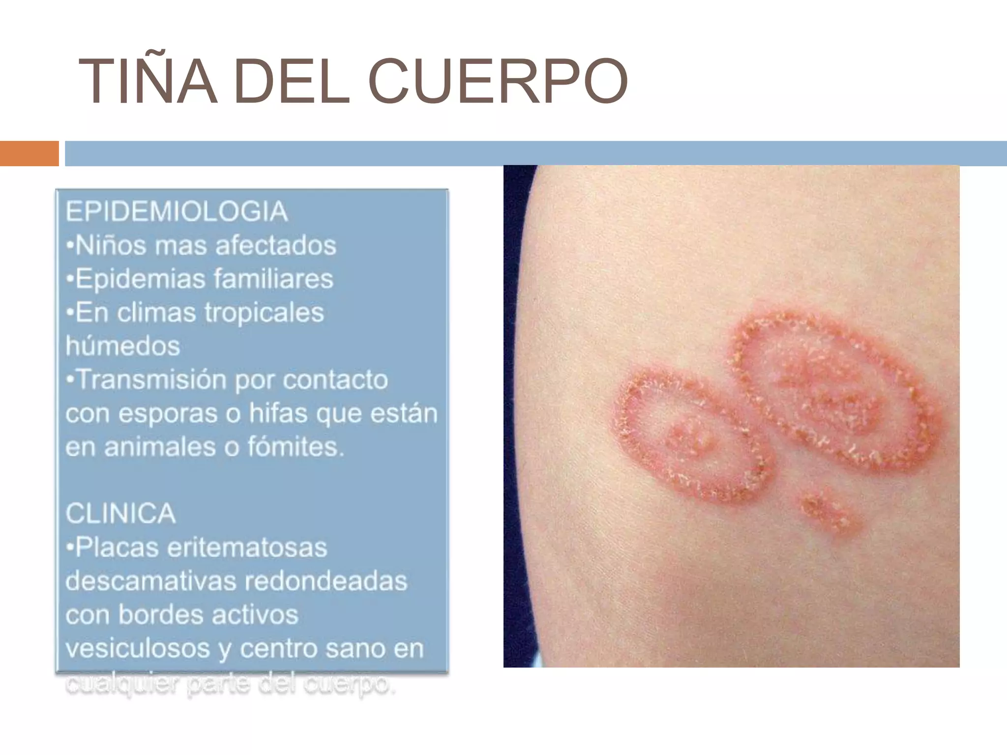 Micosis superficiales