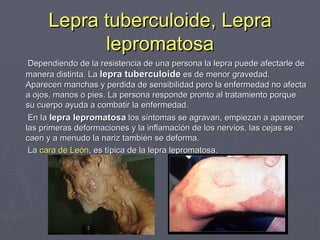 Lepra, M.R. PPT