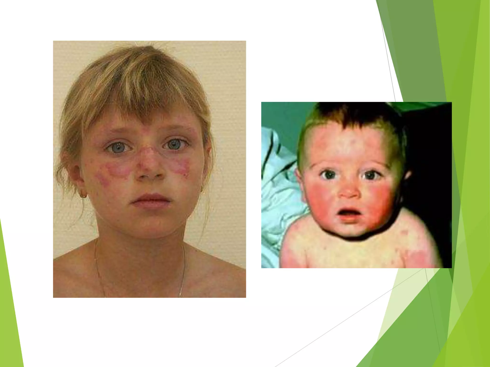 approach to child with fever and Rash | PPTX