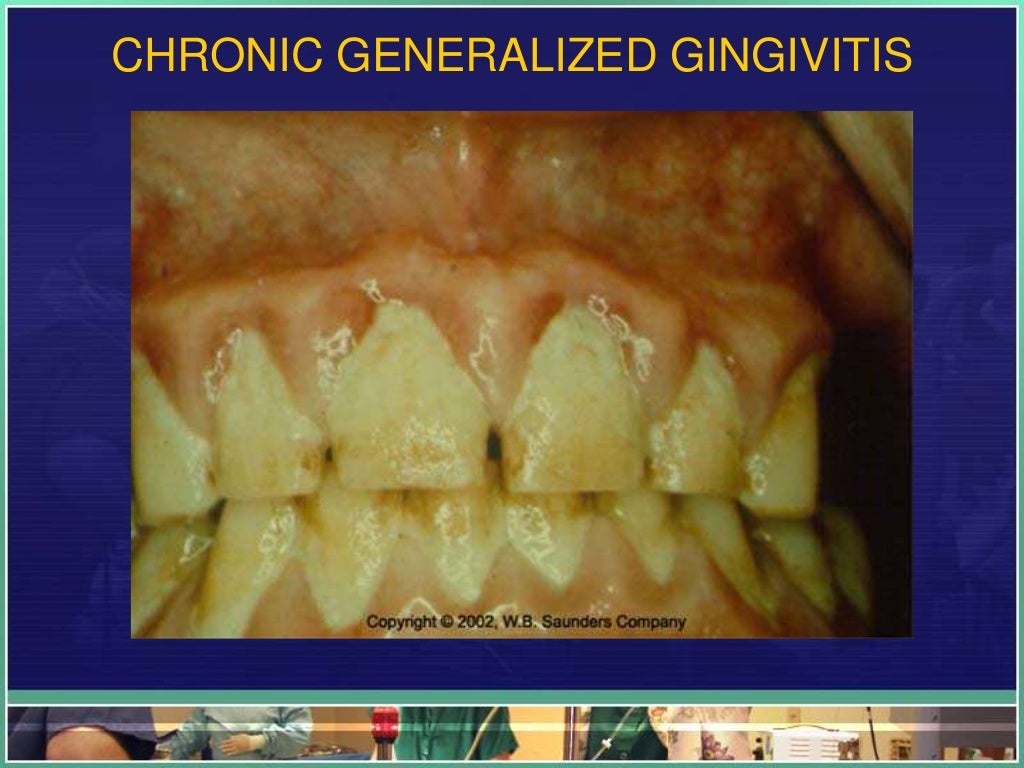Gingivitis