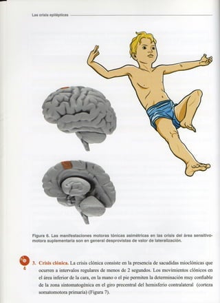 Marzia elsa   crisis-epilepticas
