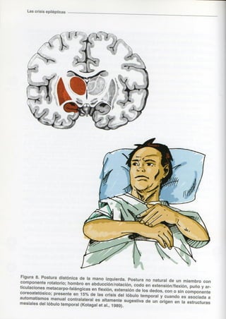 Marzia elsa   crisis-epilepticas