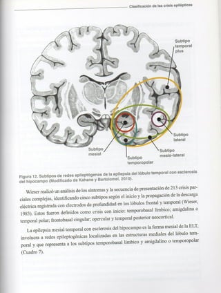 Marzia elsa   crisis-epilepticas