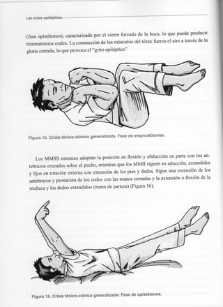 Marzia elsa   crisis-epilepticas